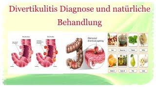 Divertikulitis Diagnose und natürliche Behandlung [upl. by Chapel353]