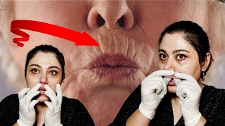 Upper lip wrinkles in 2 minutes [upl. by Myrtice]