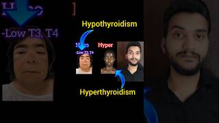 Hypothyroidism vs hyperthyroidism shorts [upl. by Cyrilla934]