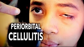 PERIORBITAL CELLULITIS Painful  Dr Paul [upl. by Gensler]