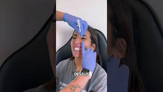 Maîtrisez le Gummy Smile Astuces dInjection 😁💉 [upl. by Giuliana]