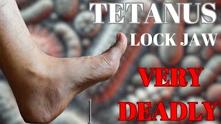 How Tetanus Can Be Very Fatal  Things to know [upl. by Aelanej]