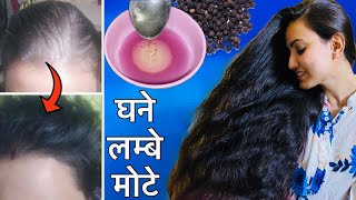 30 Days Challenge  गंजेपन Receding Hairline Bald Patches हल्के बालों को करें मोटा और घना ❤️ [upl. by Eikcim]