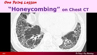 Honeycombing on Chest CT [upl. by Nahtanha]