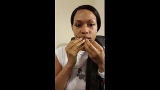 TMJ surgery Modified condylotomy Jaw wired4 week update More tips [upl. by Ramalahs759]