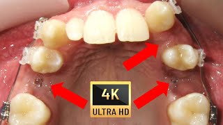 😲 Missing teeth Can orthodontics help to avoid implants⁉ Braces time lapse in 4K [upl. by Elatnahs]