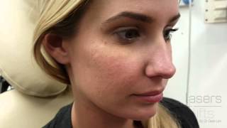 Removing acne scars in 5 minutes [upl. by Rehsa]