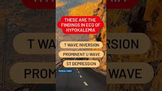 THESE ARE THE FINDINGS IN ECG OF HYPOKALEMIA [upl. by Freeman53]