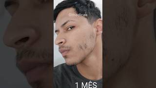 7 MESES usando MINOXIDIL antes e depois minoxidil barba thedicas [upl. by Lazor720]