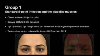 The One21 technique An individualized treatment for glabellar lines  Video abstract ID 281901 [upl. by Silvers]