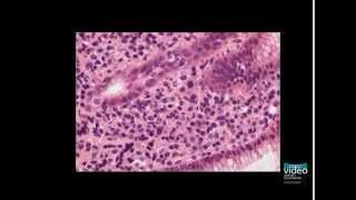 Nodular Gastritis [upl. by Yam34]