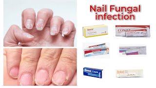 Nail Fungal infection treatment in Urdu handi  ketocinazole cream Tarbinafen cream Fungal cream [upl. by Schroer]