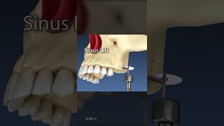 Sinus Lift Surgery 3D Animation [upl. by Beatty]