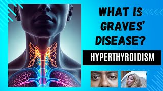 What You Need to Know About Graves Disease thyroiddisorders hyperthyroidism gravesdisease [upl. by Maffa]