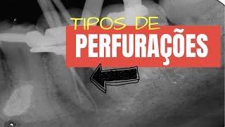 O PRIMEIRO PASSO PARA O MANEJO DE PERFURAÃ‡Ã•ES EM ENDODONTIA  QUICK TIP ENDOLOVERS [upl. by Iover]