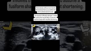 Fibromatosis colli radiology [upl. by Enileve]