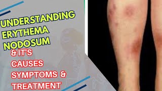 quotUnderstanding Erythema Nodosum Causes Symptoms and Treatmentquot [upl. by Notneuq]