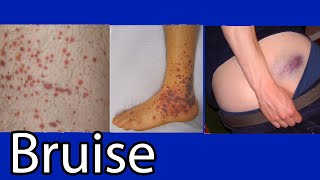 Bruise Hematoma blue spots on skin causes and treatment [upl. by Hcab904]