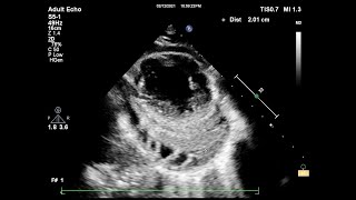 Constrictive pericarditis echocardiography [upl. by Ytomit]