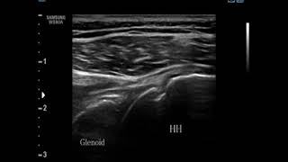 Dynamic Ultrasonography of A Patient with Posterosuperior Labral Tear Part 1 [upl. by Barnabe]