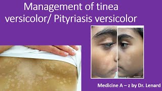 Management of tinea versicolor Pityriasis versicolor [upl. by Anaihsat88]