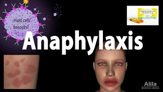 Anaphylaxis Animation [upl. by Cahn]