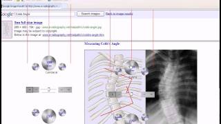 Cobb Angle Measurement [upl. by Friedland]