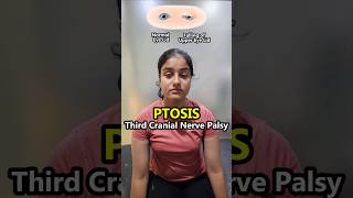 😭🥺 PTOSIS  Oculomotor nerve 3rd cranial nerve palsies Dropping of the eyelid  physiotherapy [upl. by Patric]