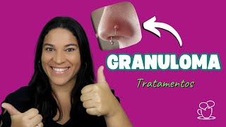 Granuloma PÓS PIERCING o que é e como tratar [upl. by Harve]