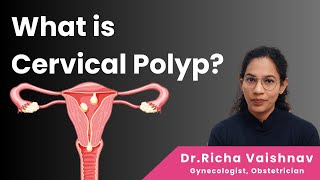 What is Cervical Polyp  Causes and Treatment  DrRicha Vaishnav [upl. by Allister]