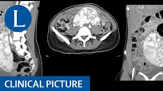 A wandering spleen splenomegaly hypersplenism and iron deficiency anaemia [upl. by Llesig]