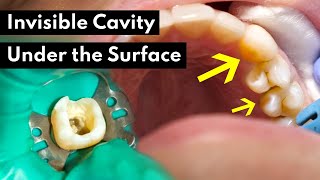 How Dentists Treat INVISIBLE CAVITIES [upl. by Youlton448]