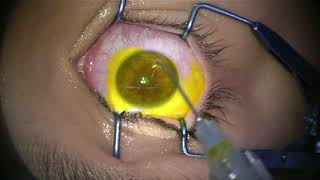 Corneal Collagen Cross Linking for Keratoconus [upl. by Asselem]