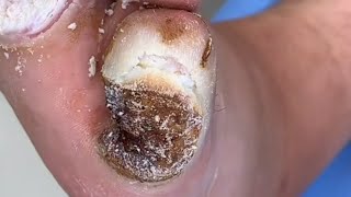 plantar warts resolved after eight treatments and clearancePedicure video 43vertical plantaris feet [upl. by Hogen]