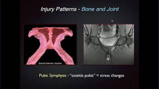 Imaging of Groin Pain Athletic Pubalgia [upl. by Elwyn]