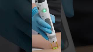 Smooth Legs Ahead Candela Laser Hair Removal at Este Medical [upl. by Sharl]