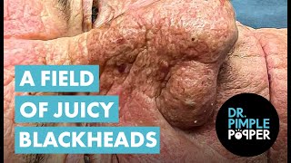 A FIELD OF JUICY BLACKHEADS [upl. by Ynneh]