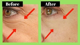 How to Remove Wrinkles Under the Eyes Naturally 2018 [upl. by Burns412]