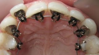 HOW BRACES WORK Awesome GOLDEN braces invisible orthodontics timelapse Incognito lingual braces [upl. by Yddet]