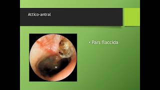 Cholesteatoma Classification  Department of ENT  Santhiram Medical College [upl. by Aicilaanna159]