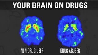 How addiction changes your brain [upl. by Teteak]