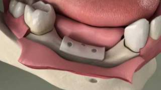 Dental Implants  Bone Grafting  Ridge Preservation in Denville NJ [upl. by Eislehc]