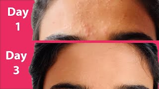 ACNE Treatment At Home  3 day Acne REMOVAL Challenge  Acne Treatment Ayurvedic with Results [upl. by Ruosnam430]