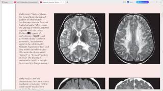 PAEDIATRIC NEURORADIOLOGY DIAGNOSTIC IMAGING [upl. by Araas]