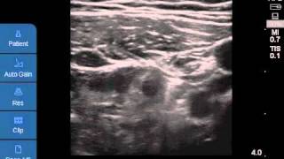 Ultrasoundguided CFNB [upl. by Graves]