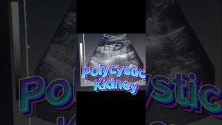 Polycystic Kidneys  Renal Cysts  Kidney Cysts on ultrasound [upl. by Agnes420]