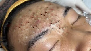 Big Cystic Acne Blackheads Extraction Blackheads amp Milia Whiteheads Removal Pimple Popping  316 [upl. by Aehta]