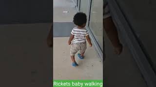 Rickets baby walking [upl. by Yonina924]