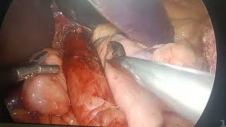 laproscopy fundoplication [upl. by Edylc]