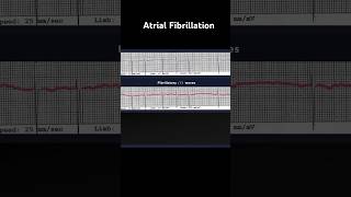 Atrial Fibrillation ECG Fibrillatory f Waves [upl. by Ididn507]